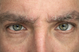 Trápia vás lupiny v obočí? Prezradíme vám príčiny, liečbu a účinnú prevenciu!